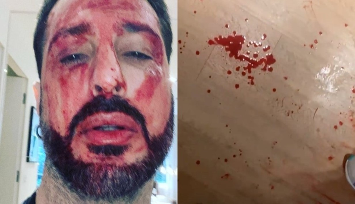 fabrizio corona domiciliari carcere sangue storie instagram